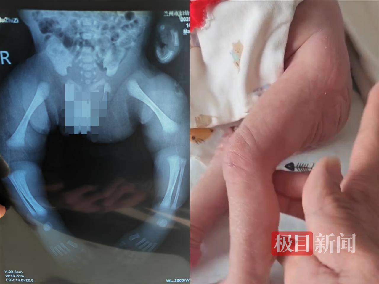 二胎出生查出先天性病症或落下残疾<strong></p>
<p>1比特币多少人民币</strong>，残疾父母称医院产检漏检、未尽告知义务，医院及医调委回应
