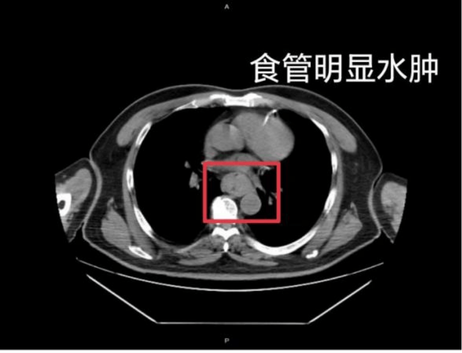 【家常话健康】一口热汤<strong></p>
<p>火币交易平台</strong>，差点要了幼童的命！不是所有东西都适合“趁热吃”