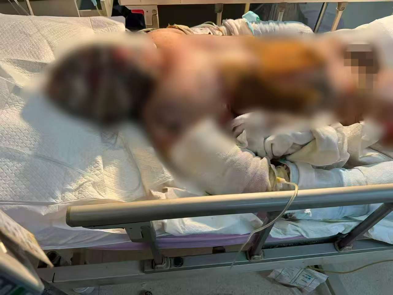 父子在哈尔滨一亲戚公司上班遇爆炸全身烧伤<strong></p>
<p>欧易下载</strong>，治疗花费近百万公司拒赔偿？亲戚回应
