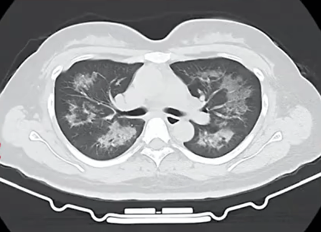 每天用2次<strong></p>
<p>虚拟货币投资</strong>，22岁女主播肺里长满阴影！很多人不注意