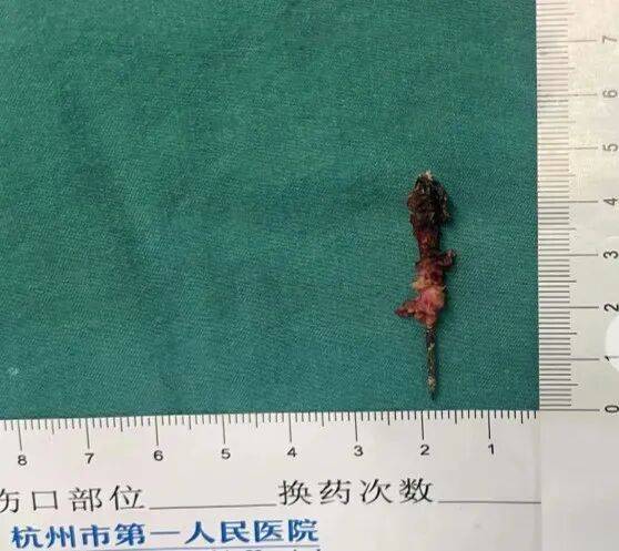 17岁小伙参军体检发现胸腔内有根5cm缝衣针<strong></p>
<p>虚拟货币是什么</strong>,父母回忆或是1岁时扎入,取出时已锈迹斑斑